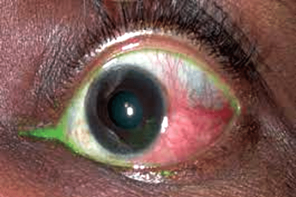 Eye-&-Systemic-Condition